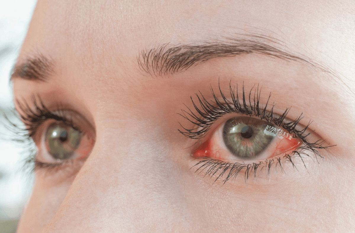 A close-up of an irritated lash line